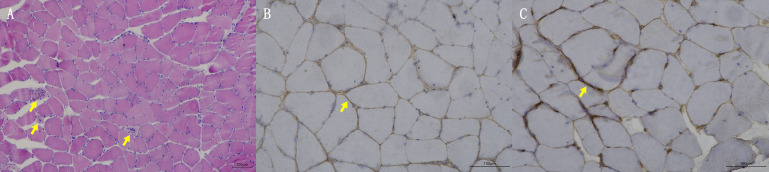 Case report: Rapid clinical improvement of anti-HMGCR immune-mediated necrotizing myopathy treated with efgartigimod.