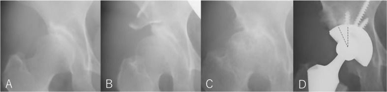 Effects of prior shelf procedure on subsequent conversion total hip arthroplasty.