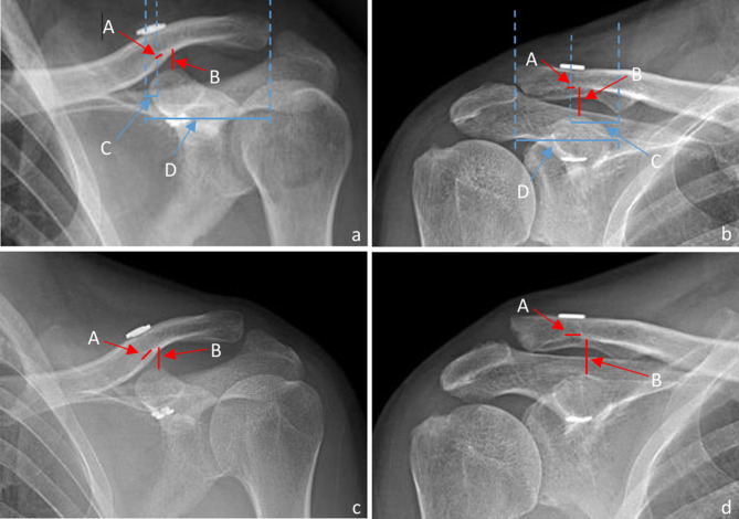 Factors influencing clavicular tunnel widening after single bundle coracoclavicular ligament reconstruction.
