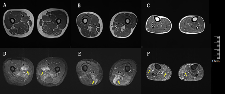 Case report: Rapid clinical improvement of anti-HMGCR immune-mediated necrotizing myopathy treated with efgartigimod.
