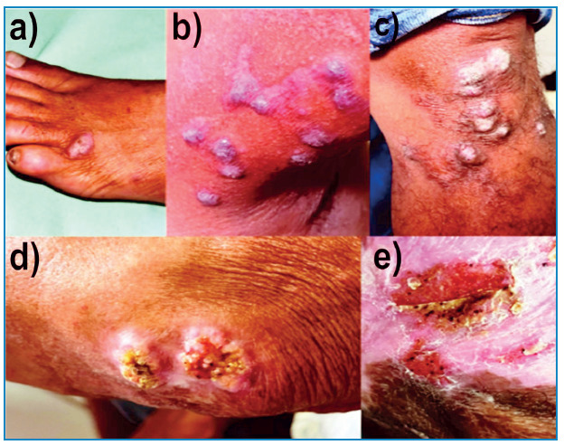 Chromoblastomycosis in Brazil: A review of 450 published cases.