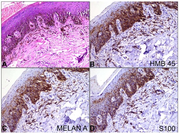 Mucosal melanoma of hard palate.