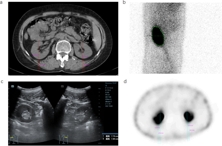Optimization and application of renal depth measurement method in the cadmium-zinc-telluride‑based SPECT/CT renal dynamic imaging.