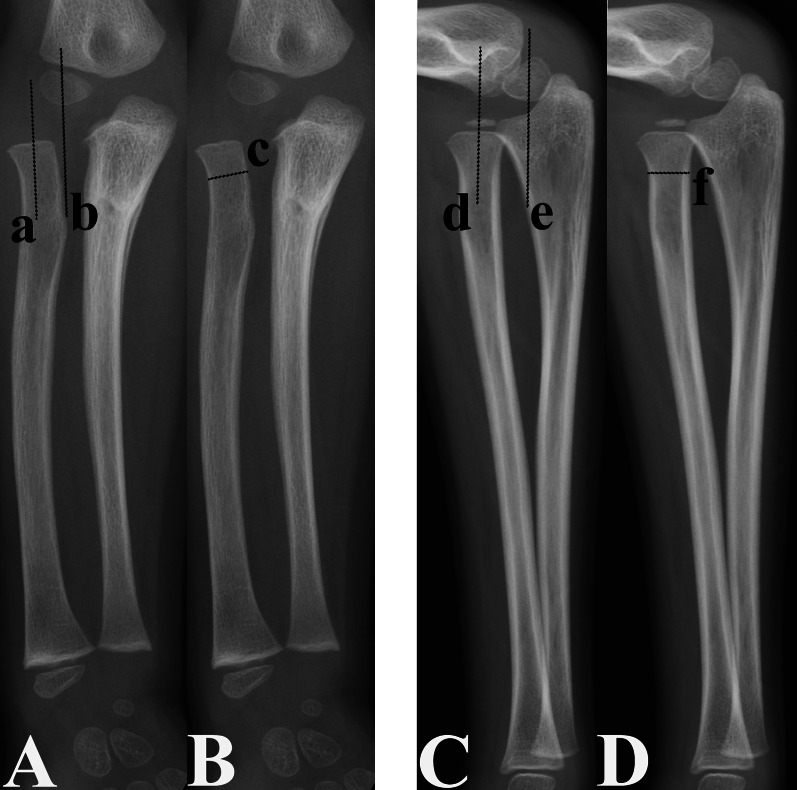 Risk factors for proximal radial abnormalities in children with untreated chronic Monteggia fractures: a review of 142 cases.