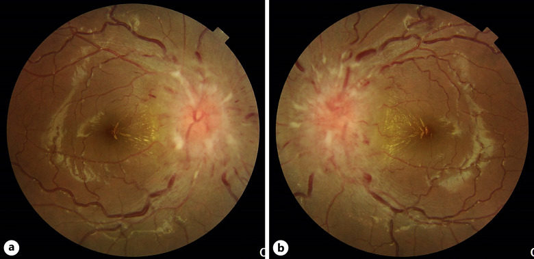 A Case of Aqueductal Stenosis with Bilateral Papilledema and Abducens Nerve Palsies without Headache.