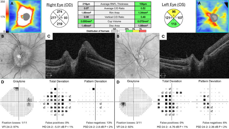 Case report: HLA-B35-associated optic neuritis.