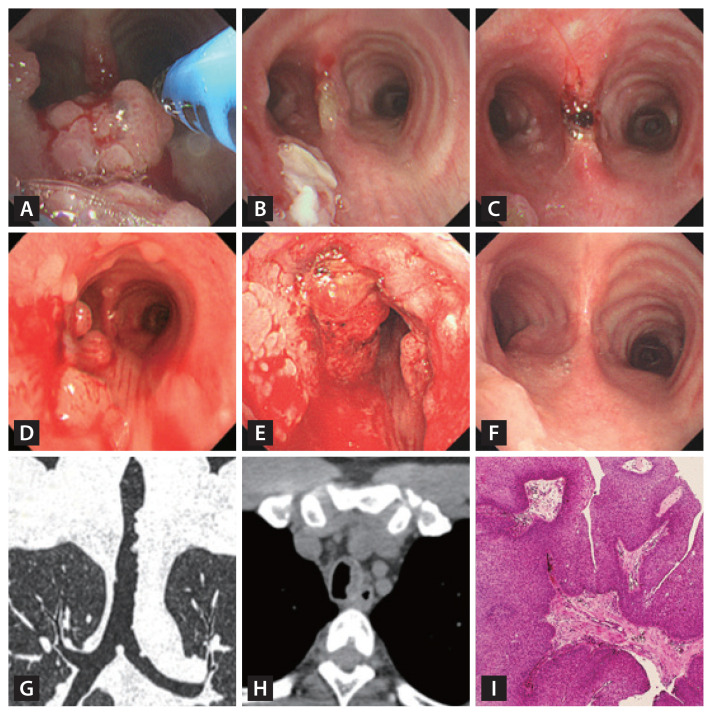 Effective control of a severely progressive recurrent respiratory papillomatosis with repetitive cryotherapy.
