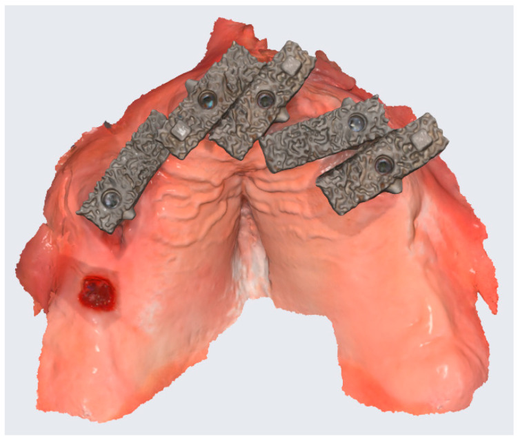 An In Vivo Comparison of Trueness and Precision of Two Novel Methods for Improving Edentulous Full Arch Implant Scanning Accuracy: A Pilot Study.