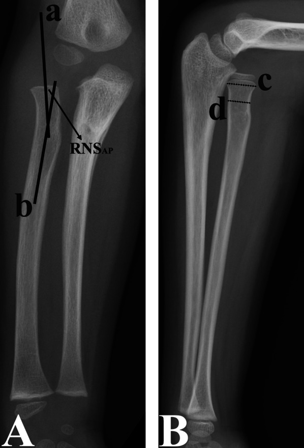Risk factors for proximal radial abnormalities in children with untreated chronic Monteggia fractures: a review of 142 cases.