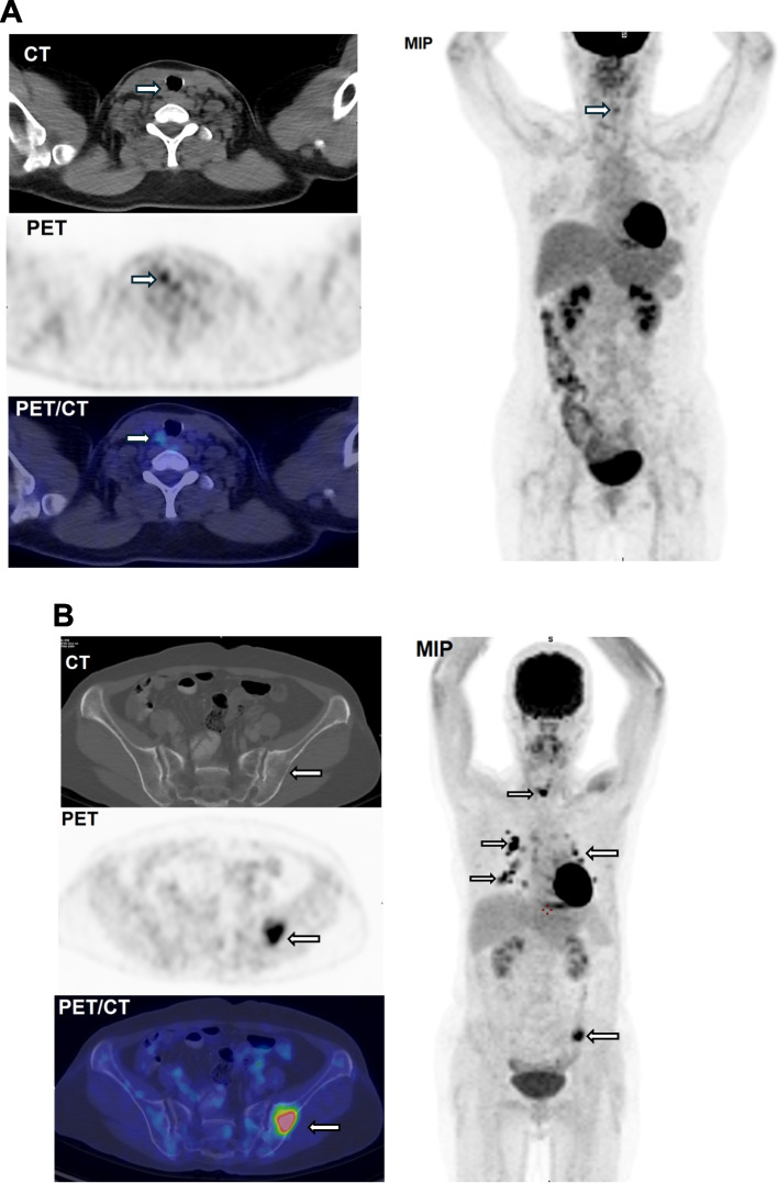 The impact of qualitative [18F]FDG PET/CT in predicting clinical outcomes of post-surgical differentiated thyroid cancer patients with elevated thyroglobulin and negative radioiodine whole-body scan.