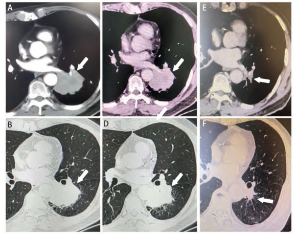 [Savolitinib Induced Pathological Complete Response in Non-small Cell Lung Cancer with MET Amplification: A Case Report].