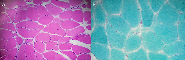 Late-onset myopathy responsive to immunomodulatory treatment: sporadic late-onset nemaline myopathy without nemaline rods?