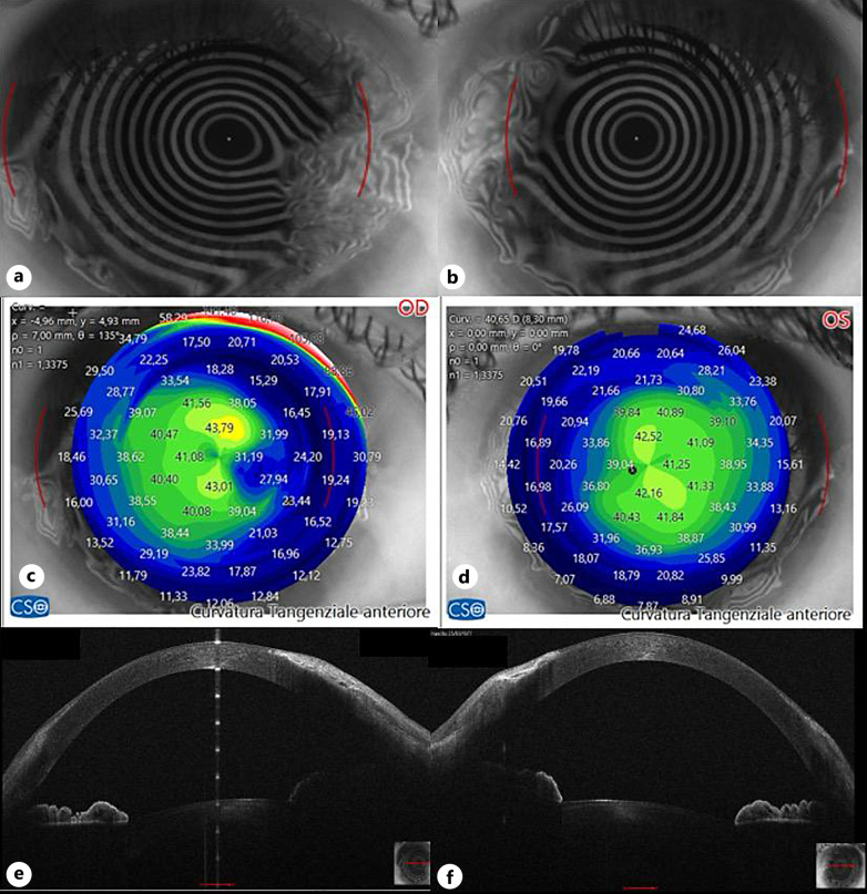 Human Amniotic Membrane Graft in the Management of Peripheral Hypertrophic Subepithelial Corneal Degeneration: A Case Report.