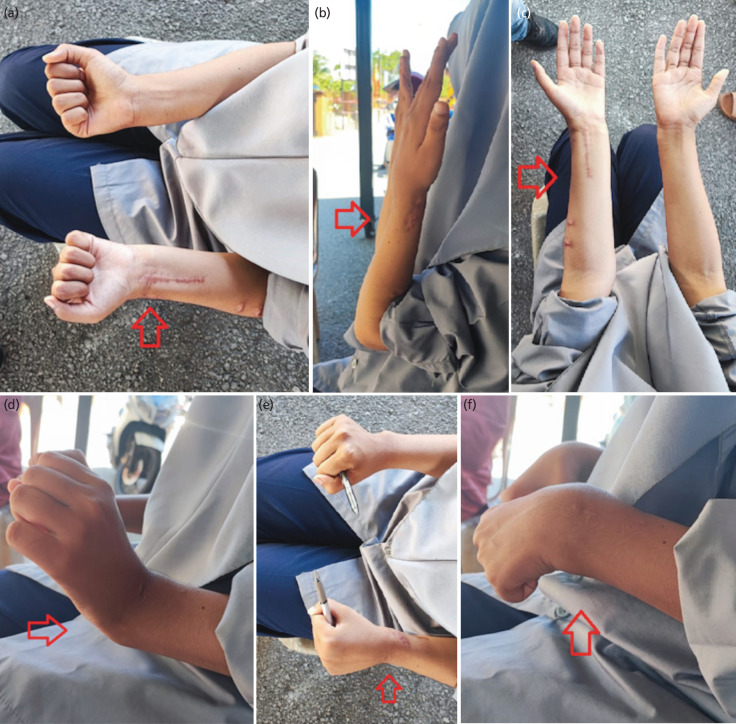 Bone Lengthening Radius using Limb Reconstruction System - A Successful Treatment for Radius Shortening: A Case Report.