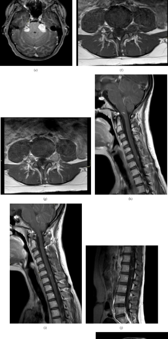 Neurofibromatosis Type 2 Presenting as Symptomatic Gallbladder Hydrops: A Rare Case Report and Literature Review.