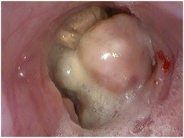 Transendoscopic laser ablation of an esophageal plasma cell tumor in a cat.