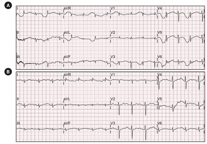 Successful neural modulation of bedside modified thoracic epidural anesthesia for ventricular tachycardia electrical storm.