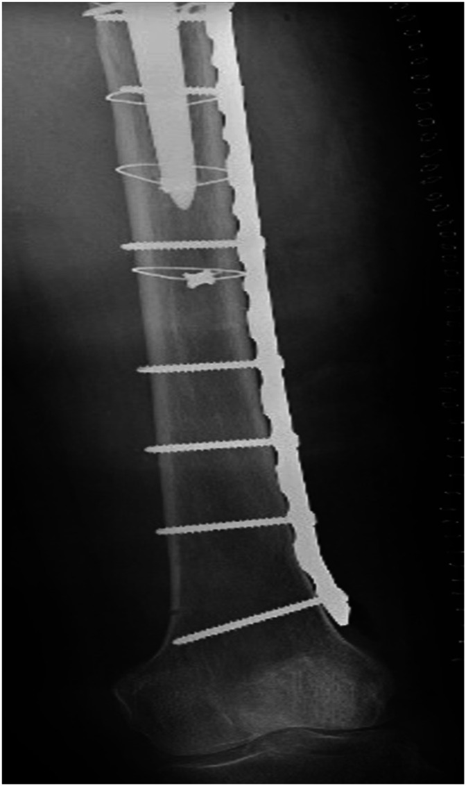Use of 1 mm Cerclage Cables in Surgical Treatment of Periprosthetic Femur Fractures.