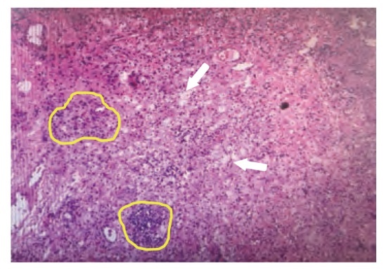 [Savolitinib Induced Pathological Complete Response in Non-small Cell Lung Cancer with MET Amplification: A Case Report].