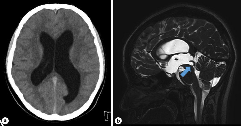 A Case of Aqueductal Stenosis with Bilateral Papilledema and Abducens Nerve Palsies without Headache.