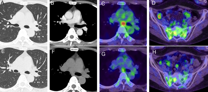 Successful immunotherapy with ipilimumab and nivolumab in a patient with pulmonary sclerosing pneumocytoma.