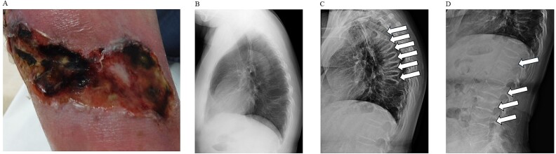 Course and treatment of severe osteoporosis complicated by calciphylaxis: a case report.