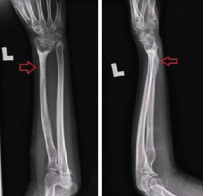 Bone Lengthening Radius using Limb Reconstruction System - A Successful Treatment for Radius Shortening: A Case Report.
