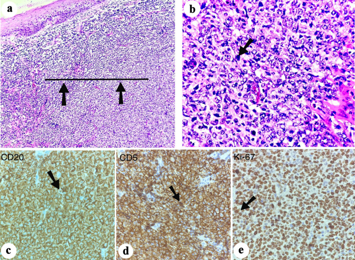 Tonsillar Diffuse Large B-Cell Lymphoma of Non-Germinal Center Type With Cluster of Differentiation 5 Positive in a Pediatric Girl.