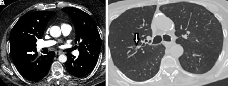 Is There a Correlation Between the Location of the Clot in the Pulmonary Arterial Tree with the Location of the Mucus Plug in the Pulmonary Bronchial Tree in Patients with chronic obstructive pulmonary disease Experiencing Pulmonary Embolism? Novel Findings.