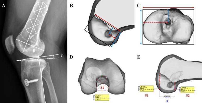 Modifiable and non-modifiable risk factors affecting surgical failure after revision ACL reconstruction: a cohort study.