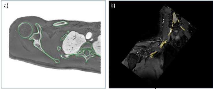 3D printing of the brachial plexus and its osseous landmarks using magnetic resonance neurography for thoracic outlet syndrome evaluation.