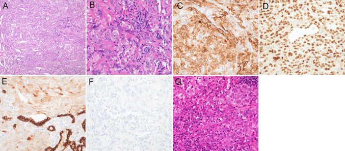 Successful immunotherapy with ipilimumab and nivolumab in a patient with pulmonary sclerosing pneumocytoma.