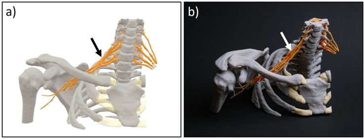 3D printing of the brachial plexus and its osseous landmarks using magnetic resonance neurography for thoracic outlet syndrome evaluation.