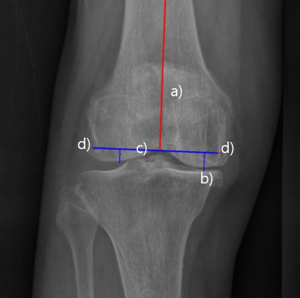 A deep learning based automatic two-dimensional digital templating model for total knee arthroplasty.