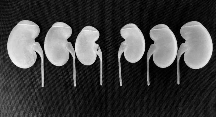 Optimization and application of renal depth measurement method in the cadmium-zinc-telluride‑based SPECT/CT renal dynamic imaging.