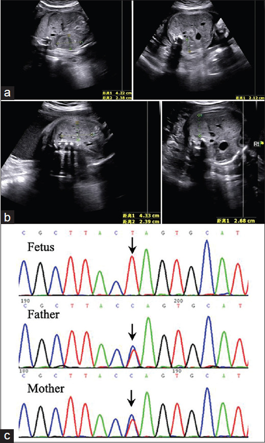 Sonographic Findings in Two Consecutive Pregnancies Affected with Fetuses of Congenital Nephrotic Syndrome of Finnish Type.