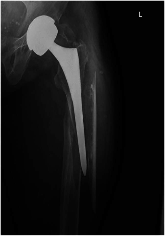 Use of 1 mm Cerclage Cables in Surgical Treatment of Periprosthetic Femur Fractures.