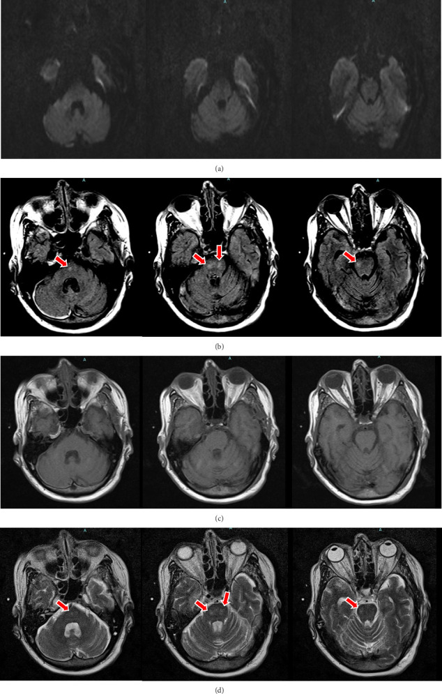 Osmotic Demyelination Syndrome in the Setting of Normonatremia: A Case Report and Review of the Literature.