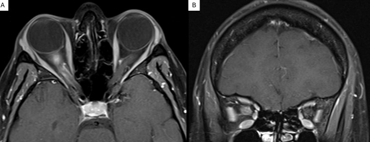 Case report: HLA-B35-associated optic neuritis.