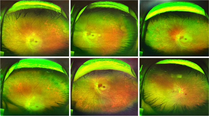 Nursing management of a patient with central retinal artery occlusion after percutaneous coronary intervention: a case report.