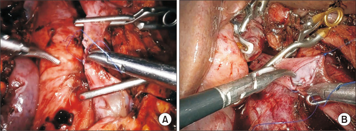 Minimally invasive pancreatoduodenectomy with combined venous vascular resection: A comparative analysis with open approach.