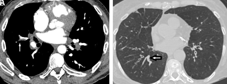Is There a Correlation Between the Location of the Clot in the Pulmonary Arterial Tree with the Location of the Mucus Plug in the Pulmonary Bronchial Tree in Patients with chronic obstructive pulmonary disease Experiencing Pulmonary Embolism? Novel Findings.