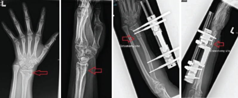 Bone Lengthening Radius using Limb Reconstruction System - A Successful Treatment for Radius Shortening: A Case Report.