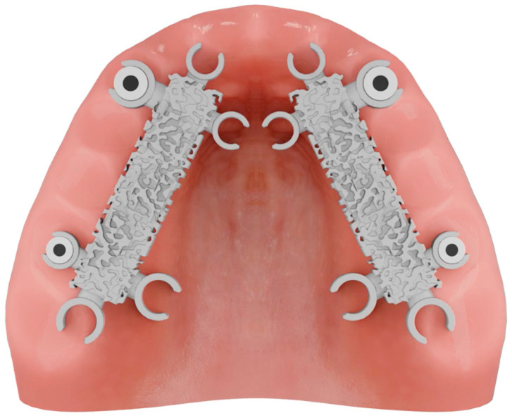 An In Vivo Comparison of Trueness and Precision of Two Novel Methods for Improving Edentulous Full Arch Implant Scanning Accuracy: A Pilot Study.