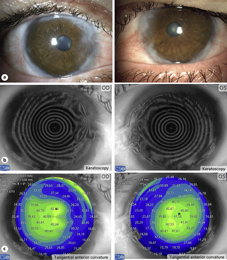 Human Amniotic Membrane Graft in the Management of Peripheral Hypertrophic Subepithelial Corneal Degeneration: A Case Report.