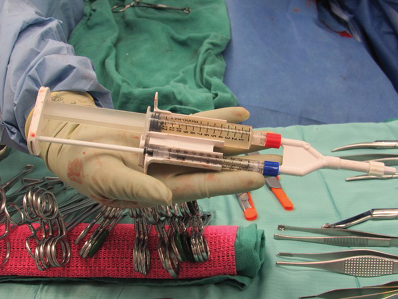 The Collection and Application of Autologous Amniotic Fluid to Cesarean Delivery Closure.