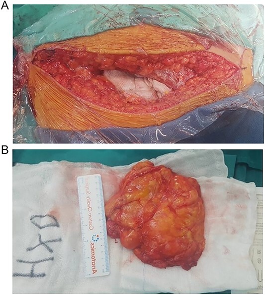 Transgluteal approach for excision of pelvic lipoma causing sciatic pain.
