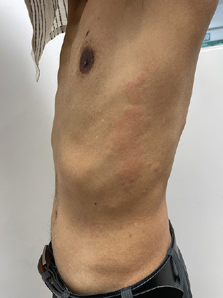 Mirabegron-induced acute urticaria: An uncommon cutaneous adverse drug reaction.