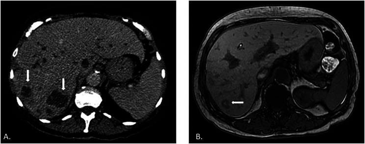 Paracoccidioidomycosis presenting as a cecal lesion mimicking cholangiocarcinoma: a case report of unusual intestinal manifestation.