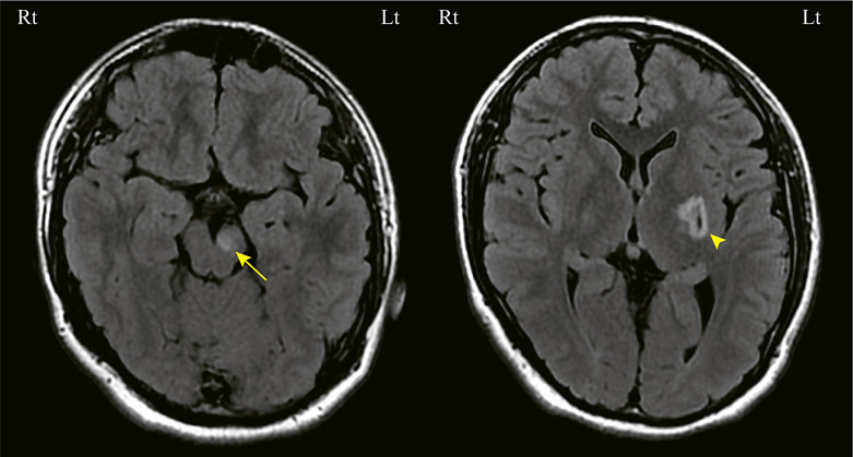 Leber Hereditary Optic Neuropathy "Plus" with the m.14487 T>C Mutation as the Causality of Hemidystonia: A Case Report.